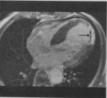 Снимки МРТ и КТ. Инфаркт миокарда