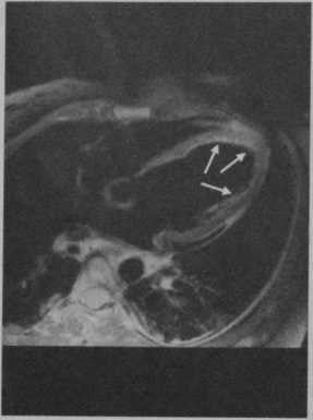 Снимки МРТ и КТ. Г иперэозинофильный синдром (эндокардит Леффлера)