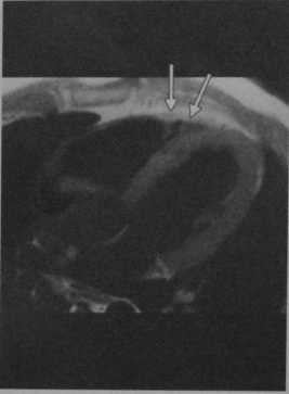 Снимки МРТ и КТ. Аритмогенная кардиомиопатия правого желудочка