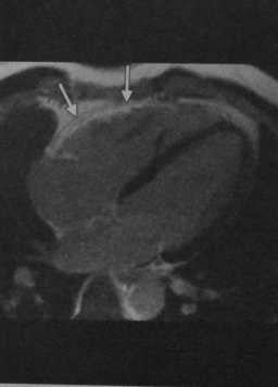 Снимки МРТ и КТ. Аритмогенная кардиомиопатия правого желудочка