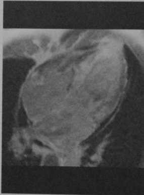 Снимки МРТ и КТ. Амилоидоз
