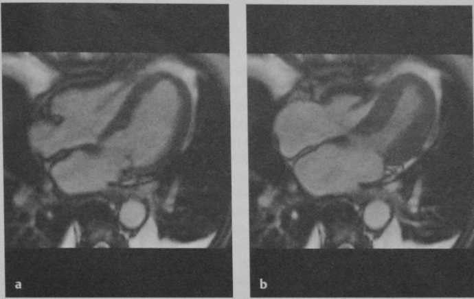 Снимки МРТ и КТ. Шаровидное расширение верхушки сердца