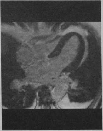Снимки МРТ и КТ. Шаровидное расширение верхушки сердца