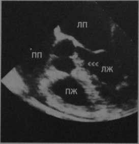 Снимки МРТ и КТ. Инфекционный эндокардит