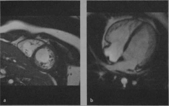 Снимки МРТ и КТ. Неклассифицированные кардиомиопатии