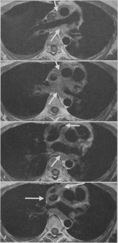 Снимки МРТ и КТ. Саркома легочной артерии