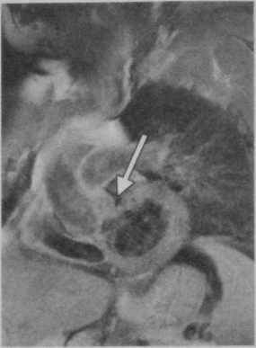 Снимки МРТ и КТ. Папиллярная фиброэластома