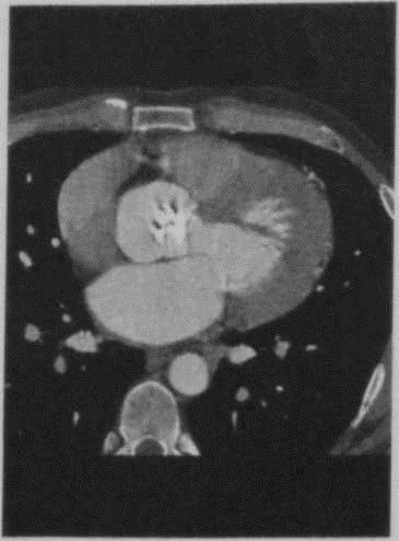 Снимки МРТ и КТ. Аортальный стеноз