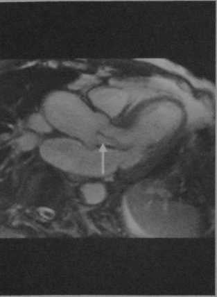 Снимки МРТ и КТ. Недостаточность аортального клапана