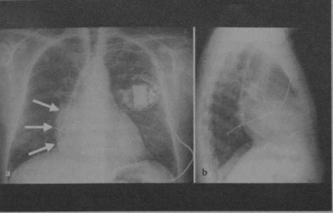 Снимки МРТ и КТ. Недостаточность клапана легочного ствола