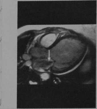 Снимки МРТ и КТ. Недостаточность митрального клапана