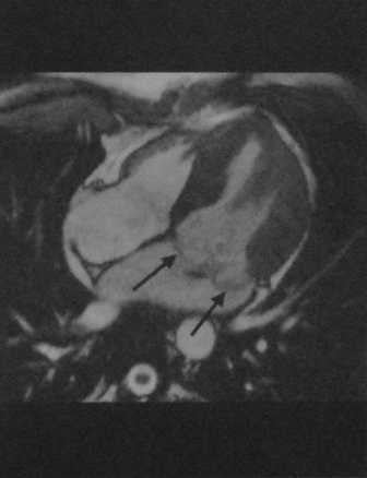 Снимки МРТ и КТ. Пролапс митрального клапана