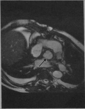 Снимки МРТ и КТ. Протезирование аортального клапана по Россу