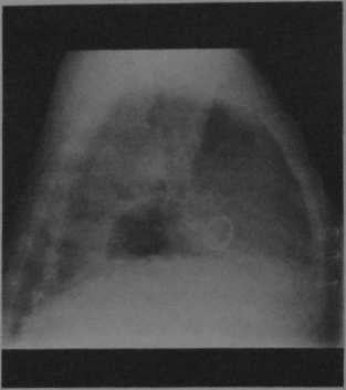 Снимки МРТ и КТ. Искусственные клапаны сердца