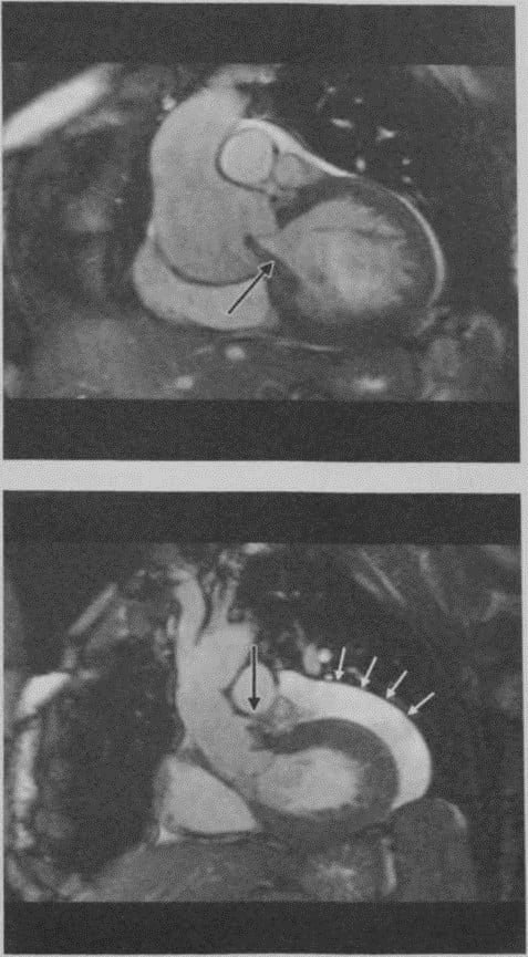 Снимки МРТ и КТ. Реконструкция аортального клапана