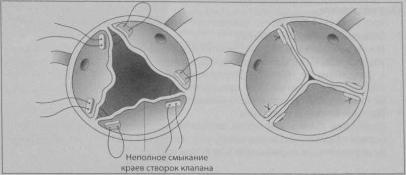 Снимки МРТ и КТ. Реконструкция аортального клапана