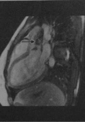 Снимки МРТ и КТ. Сочетанные поражения клапанного аппарата сердца