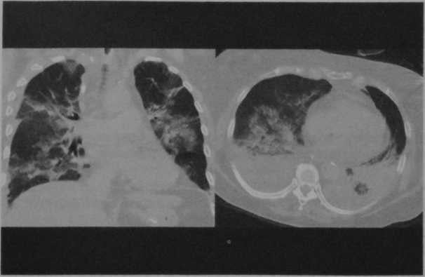 Снимки МРТ и КТ. Острая сердечная недостаточность
