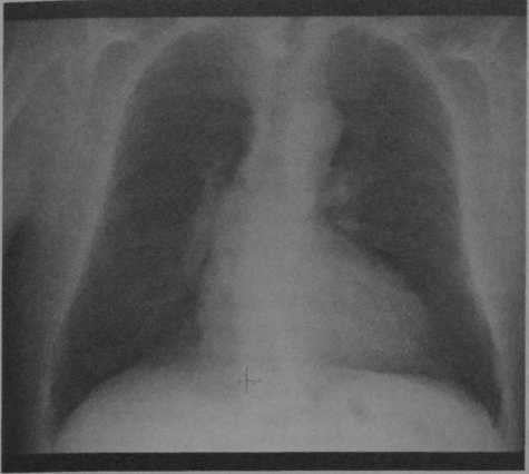 Снимки МРТ и КТ. Транспозиция крупных артерий (декстротранспозиция)