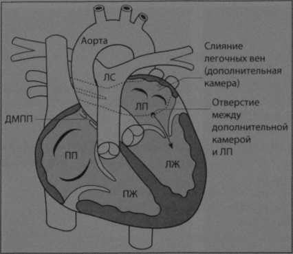 Снимки МРТ и КТ. Трехпредсердное сердце