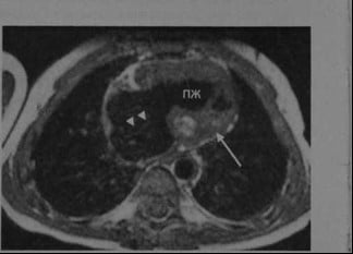 Снимки МРТ и КТ. Синдром гипоплазии левых отделов сердца