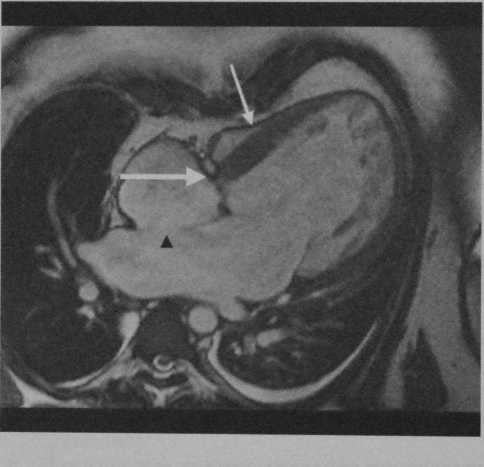 Снимки МРТ и КТ. Атрезия трикуспидального клапана