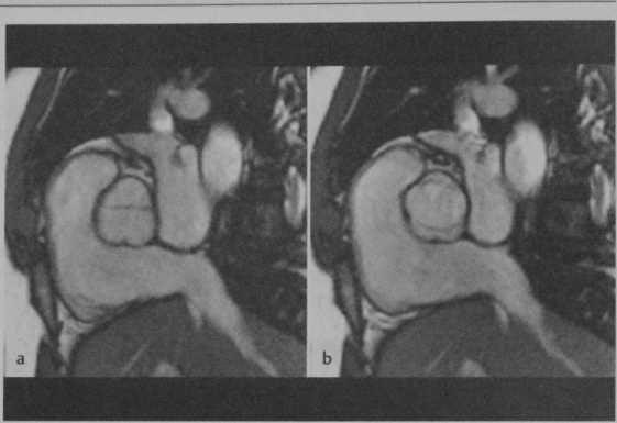 Снимки МРТ и КТ. Бикуспидальный аортальный клапан