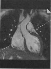 Снимки МРТ и КТ. Бикуспидальный аортальный клапан