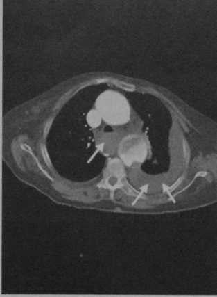 Снимки МРТ и КТ. Разрыв аорты
