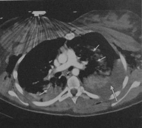 Снимки МРТ и КТ. Разрыв легочной артерии