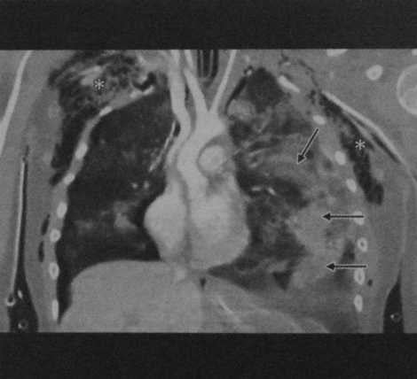 Снимки МРТ и КТ. Разрыв легочной артерии