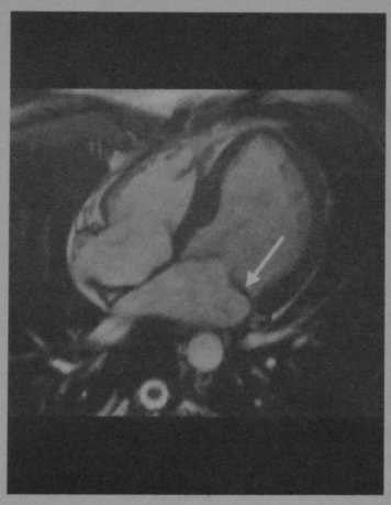 Снимки МРТ и КТ. Расслоение аорты