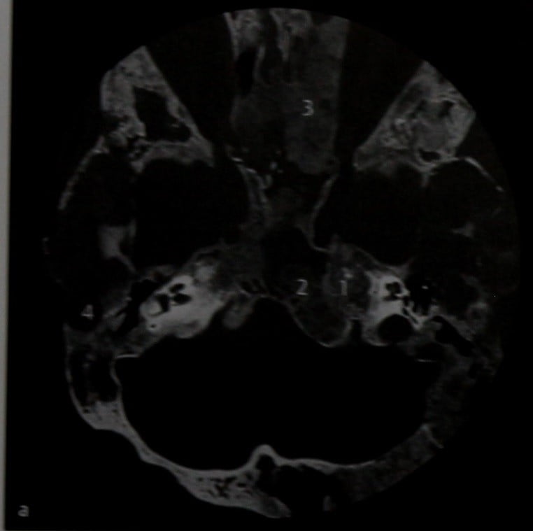 Снимки МРТ и КТ. Фиброзная дисплазия основания черепа