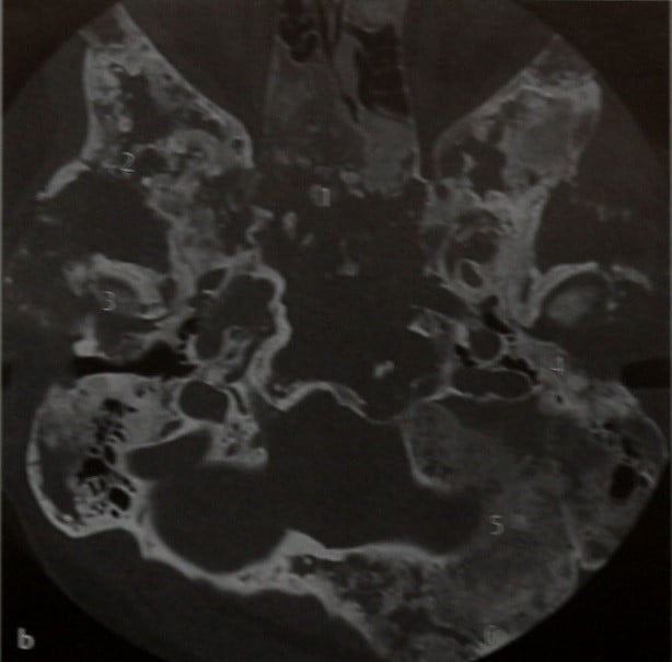 Снимки МРТ и КТ. Фиброзная дисплазия основания черепа