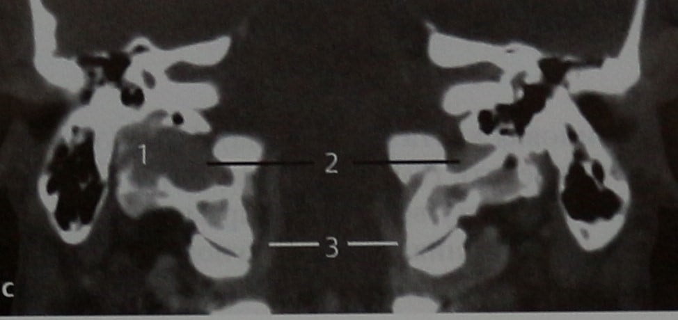 Снимки МРТ и КТ. Гломусная опухоль (яремная параганглиома)