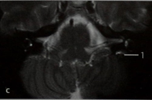 Снимки МРТ и КТ. Опухоль эндолимфатического мешка: болезнь Гиппеля 
