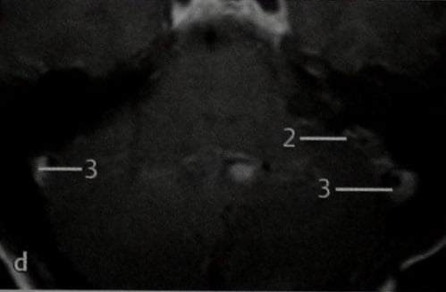 Снимки МРТ и КТ. Опухоль эндолимфатического мешка: болезнь Гиппеля 