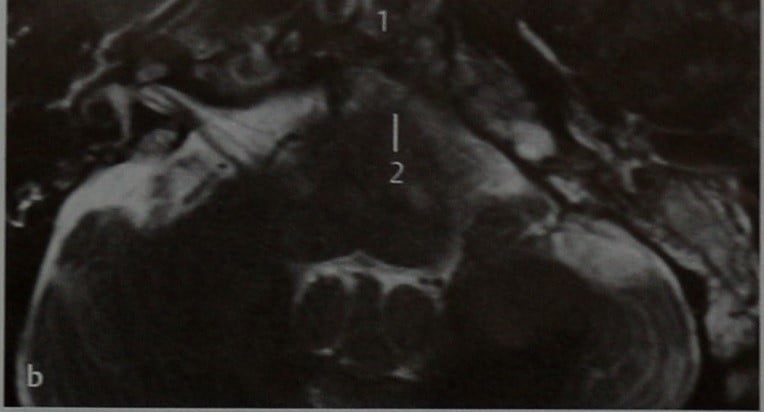 Снимки МРТ и КТ. Воспалительный процесс в области основания черепа 
