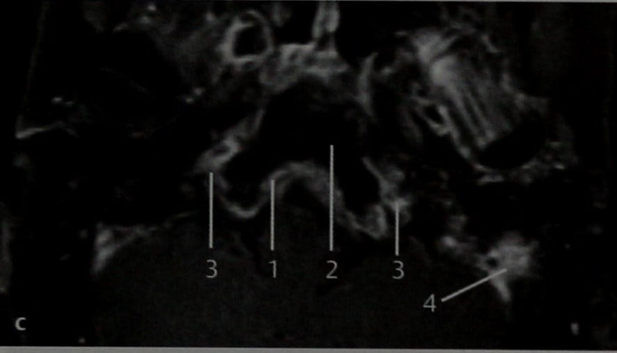 Снимки МРТ и КТ. Воспалительный процесс в области основания черепа 