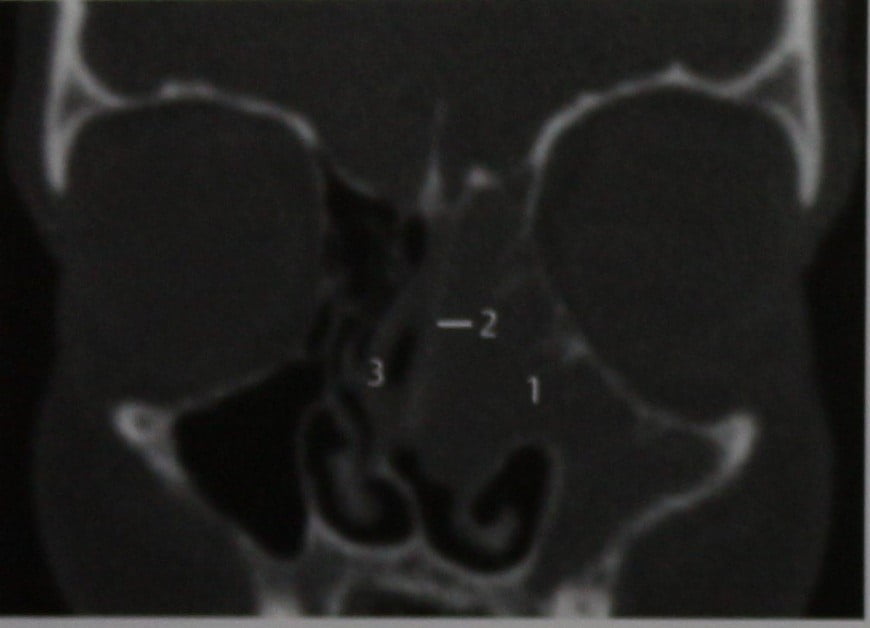 Снимки МРТ и КТ. Полипы одной половины носовой полости