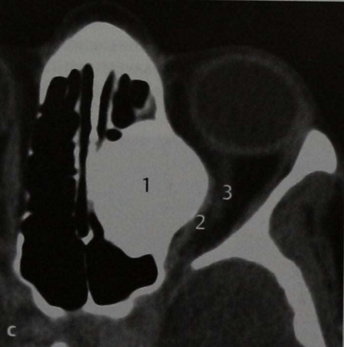 Снимки МРТ и КТ. Монооссальная фиброзная дисплазия