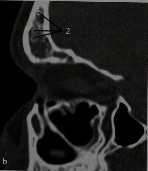 Снимки МРТ и КТ. Неинвазивный грибковый синусит