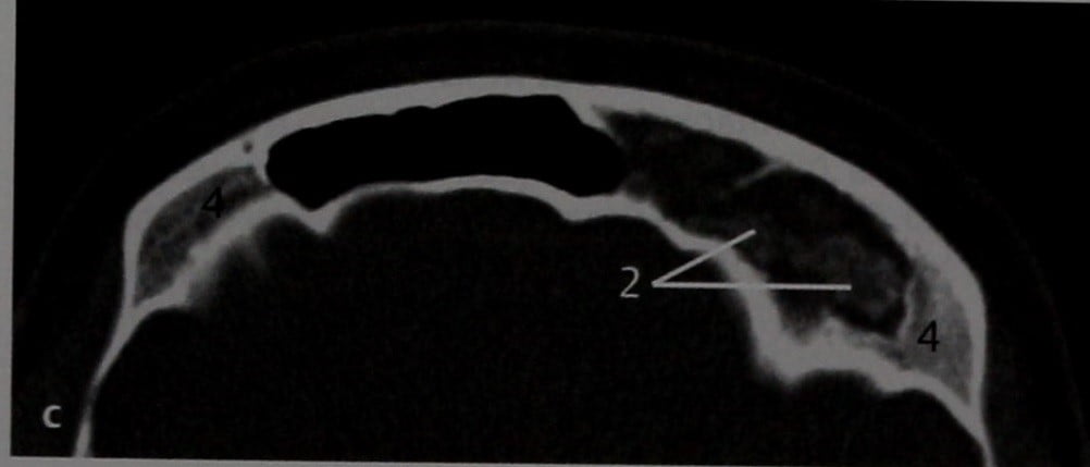 Снимки МРТ и КТ. Неинвазивный грибковый синусит