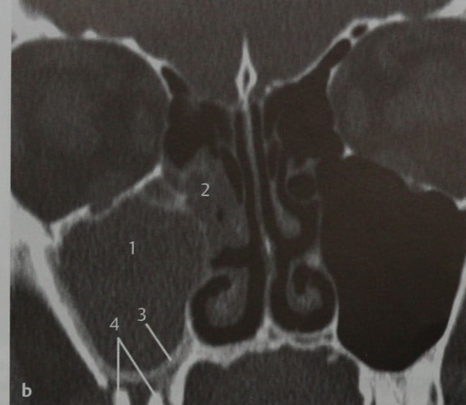 Снимки МРТ и КТ. Одонтогенный синусит