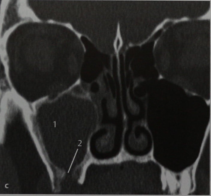 Снимки МРТ и КТ. Одонтогенный синусит