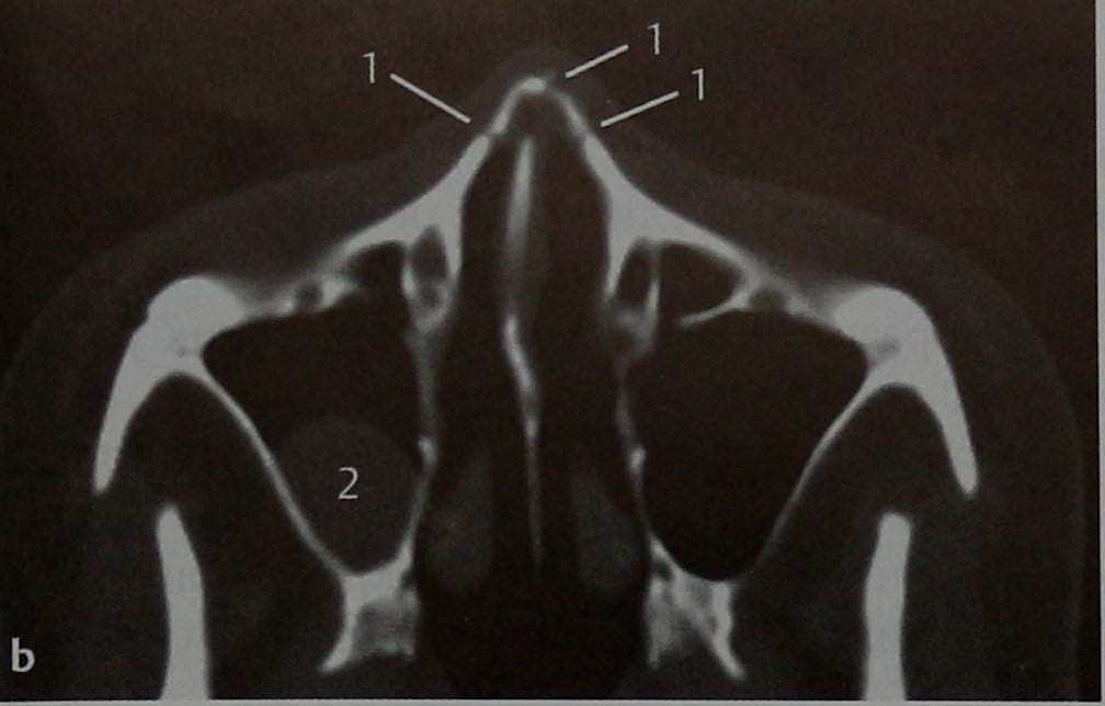 Снимки МРТ и КТ. Перелом носовых костей и ретенционные кисты
