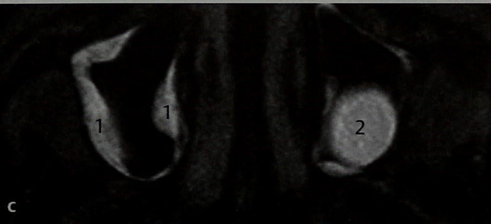 Снимки МРТ и КТ. Перелом носовых костей и ретенционные кисты