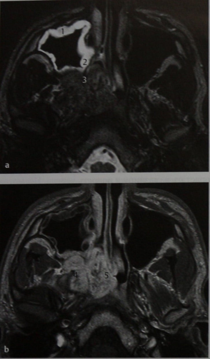 Снимки МРТ и КТ. Ювенильная ангиофиброма