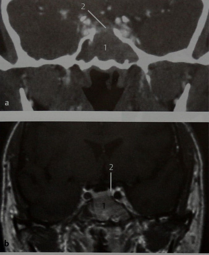 Снимки МРТ и КТ. Переходно-клеточная папиллома