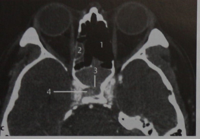 Снимки МРТ и КТ. Переходно-клеточная папиллома